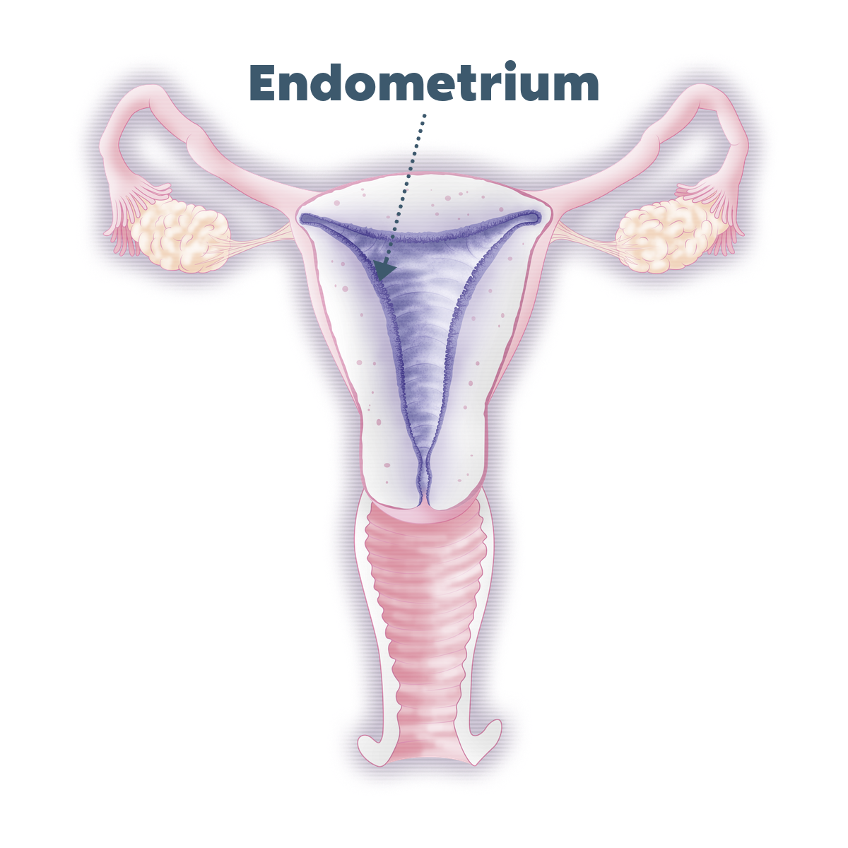 什麼是EndomeTRIO 子宮內膜三合一檢測？EndomeTRIO子宮內膜三合一檢測是完整的子宮內膜分析，包括ERA、EMMA及ALICE。